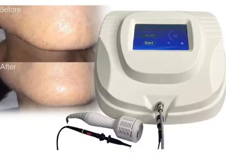 Electrolysis Hair Removal Device
