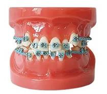 Orthodontic Metal and Ceramic Model