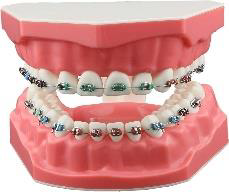 Orthodontic Metal Brackets Model