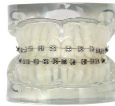 Orthodontic Transparent Metal Bracket Model